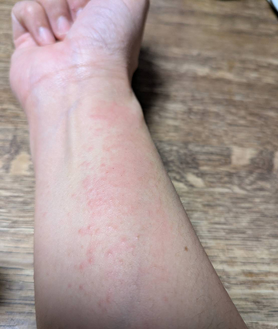 遅延型アレルギー